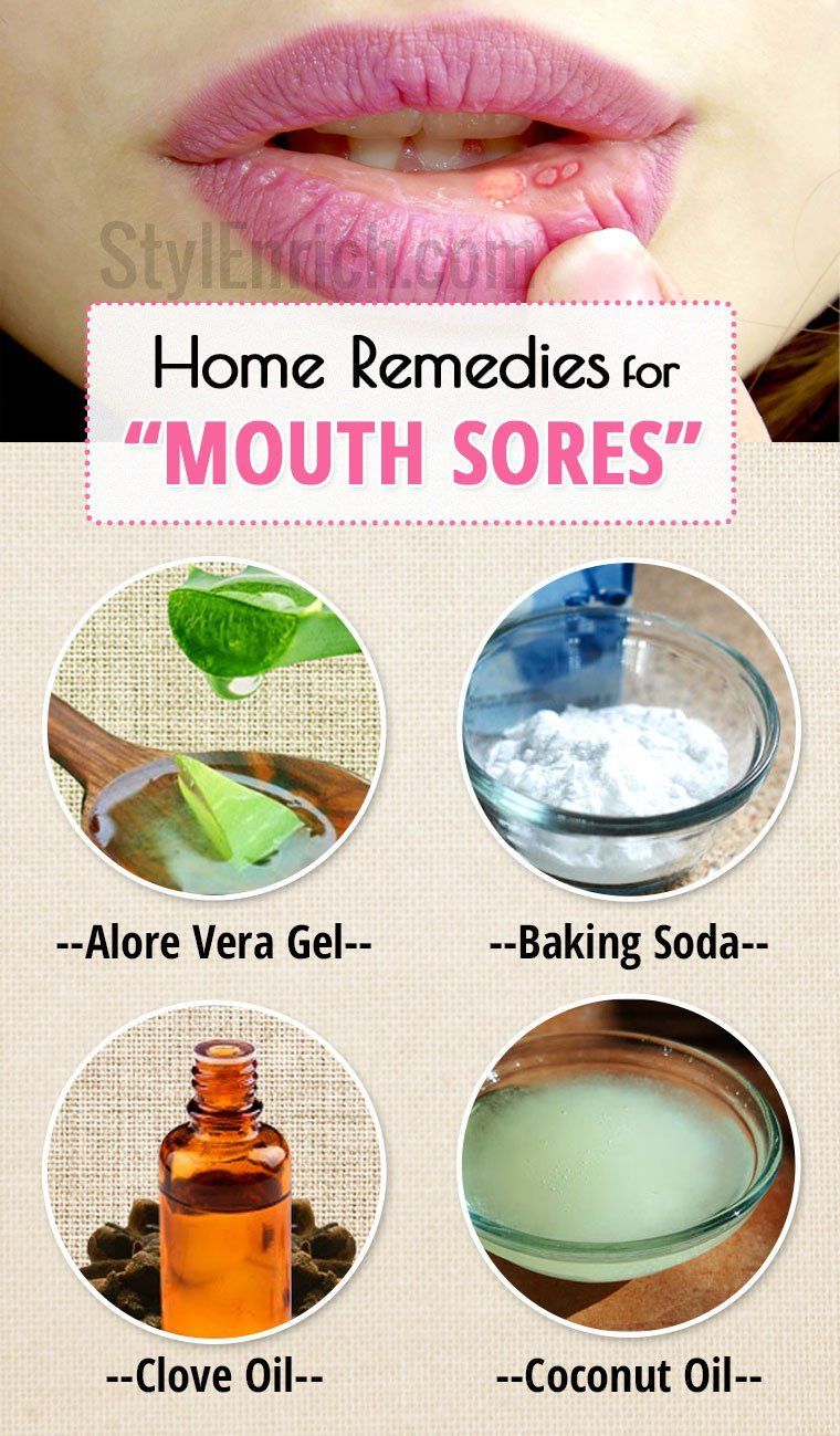 best home remedy for cold sore in mouth