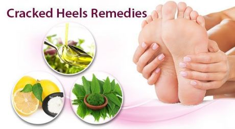 7 Incredible Home Remedies for Cracked Heals