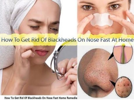 HOW TO REMOVE BLACKHEADS FROM NOSE AT HOME
